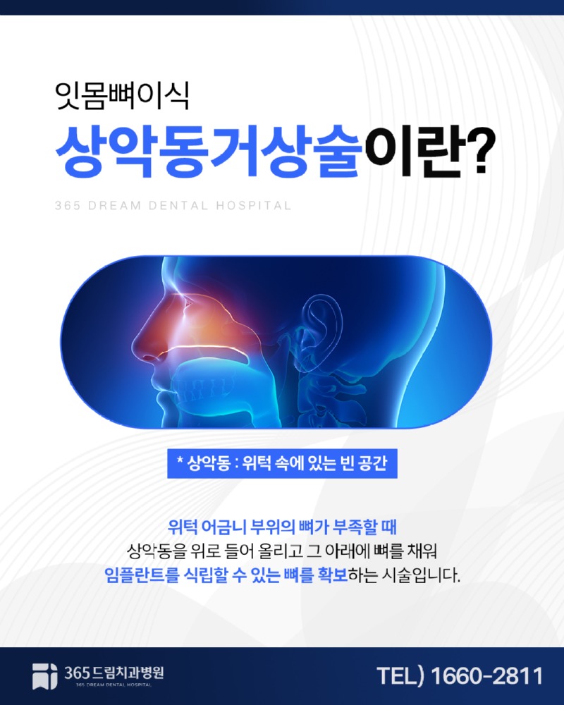 망미동 상악동거상술 블로그_2.jpg