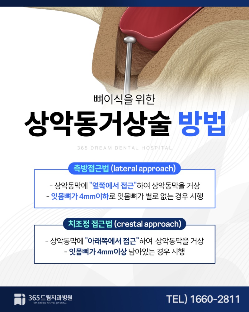 망미동 상악동거상술 블로그_4.jpg