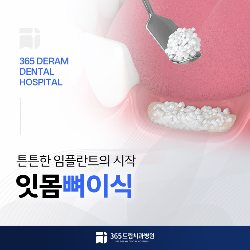 대연동 잇몸뼈이식 썸네일_1.jpg