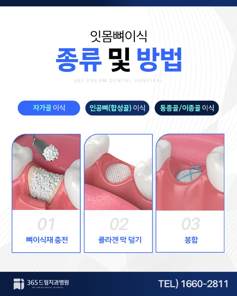 대연동 잇몸뼈이식 블로그_3.jpg