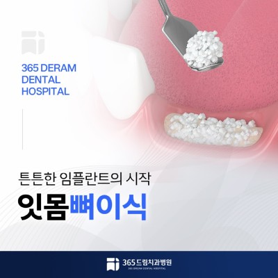 대연동 잇몸뼈이식 썸네일_1.jpg