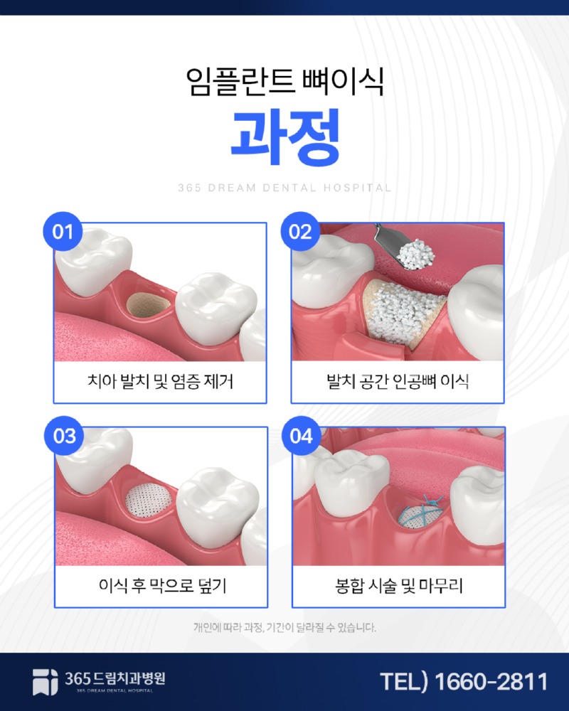해운대 임플란트 블로그_3.jpg