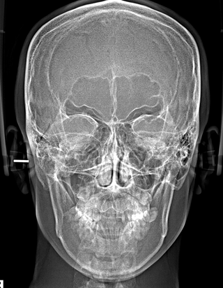 13_X-RAY 정면 전(1).png