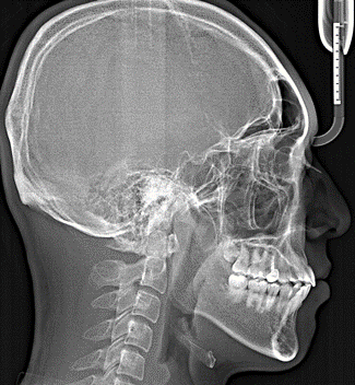 16_X-RAY 측면 후(1).png
