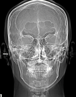 15_X-RAY 정면 후(1).png