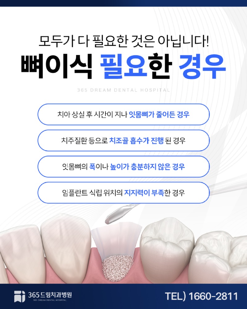 센텀 임플란트 블로그_3.jpg