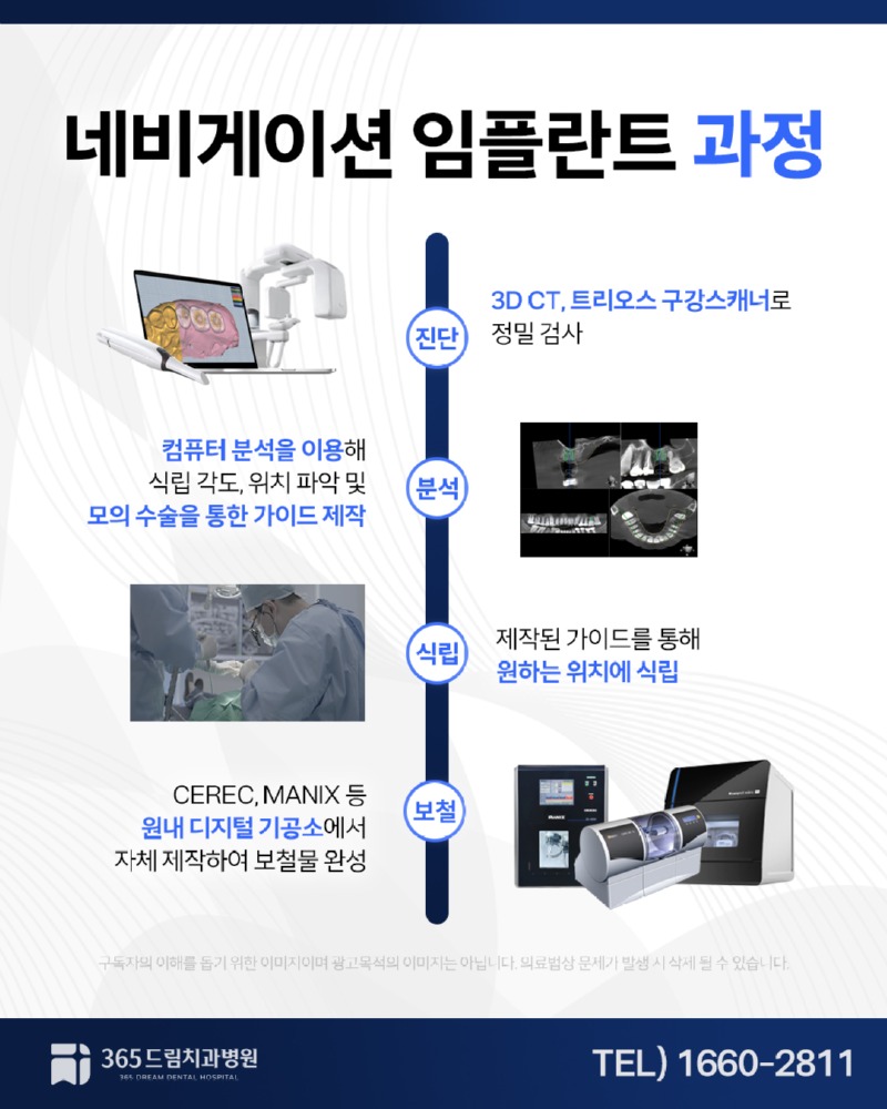 부산네비게이션임플란트 블로그_3.jpg