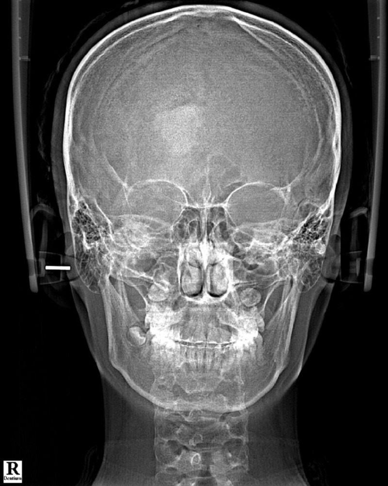 14_X-RAY 정면 후(1).jpg