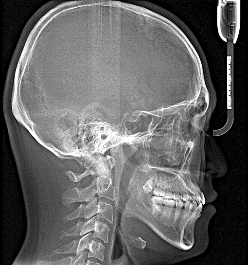19_X-RAY 측면 전(1).png