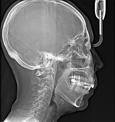 16_X-RAY 후(1).png