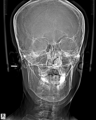 14_X-RAY 전(2).png
