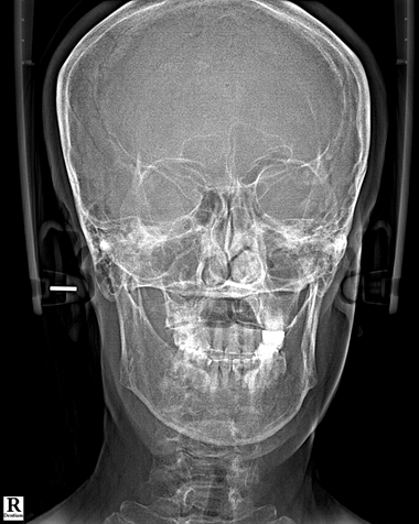 17_X-RAY 후(2).png