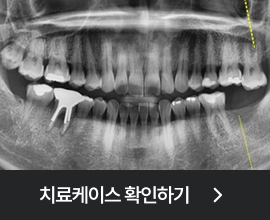 최소침습 임플란트 치료케이스 확인하기