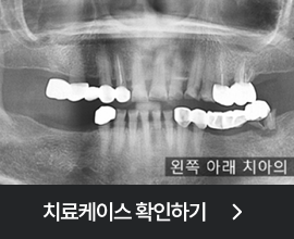 365플러스 임플란트 치료케이스 확인하기