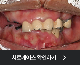 전체임플란트 치료케이스 확인하기 첫번째