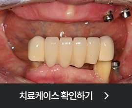 전체임플란트 치료케이스 확인하기 두번째