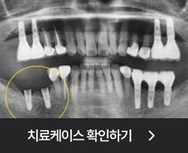 재수술고난도임플란트 치료케이스 보기